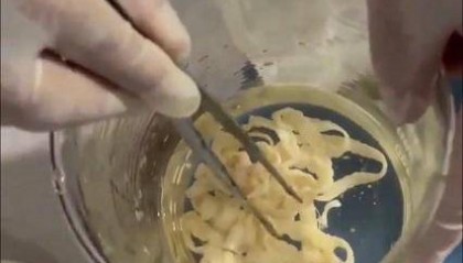 女子体内排出10米长绦虫!原是两年前旅游时吃了这种食物