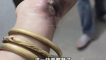 一瞬间手被烧熟,金手镯被电碎!女子给电动车充电,不慎碰到充电口受伤