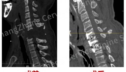 全球罕见!“身首离断”患者被救回 主刀医生:术毕两月整,已脱离呼吸机半月