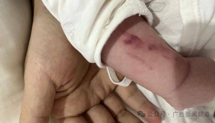 广西一月子中心有宝宝右手两处骨折,家属求真相,警方介入调查