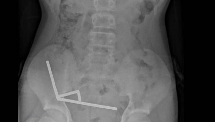 腹痛4天后送医,新西兰男孩吞下约100颗磁铁致肠道坏死 医生切除部分肠组织