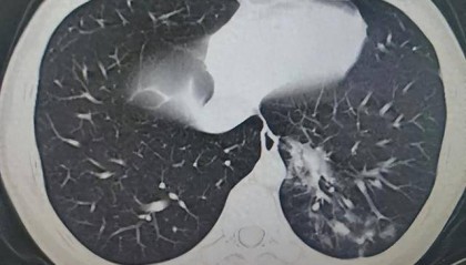 14岁男生4天高烧不退!一查不是甲流,竟是这种感染