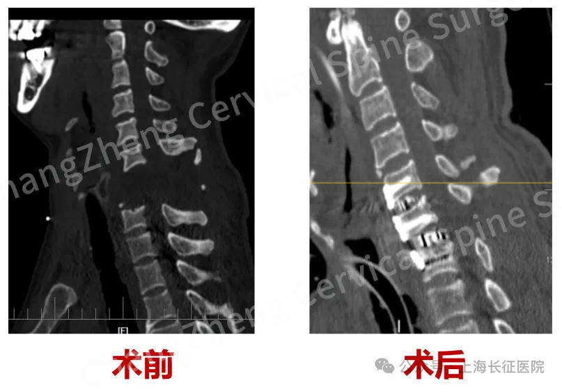 全球罕见!“身首离断”患者被救回 主刀医生:术毕两月整,已脱离呼吸机半月