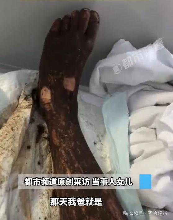 安徽宣城一男子走路玩手机，一脚踩中打架的竹叶青和五步蛇，被俩毒蛇咬3口！医院：暂无生命危险，正在治疗